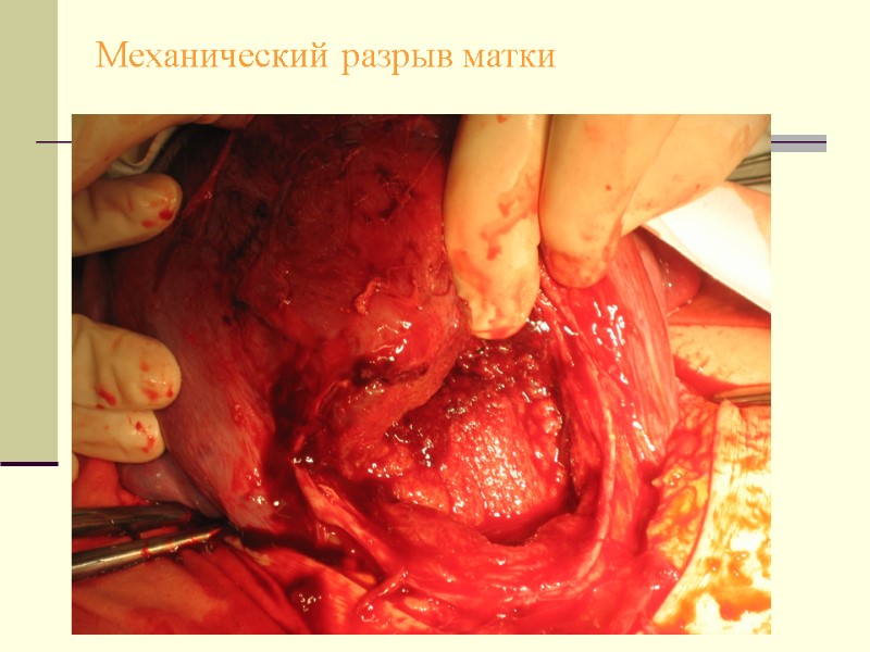 Механический разрыв матки